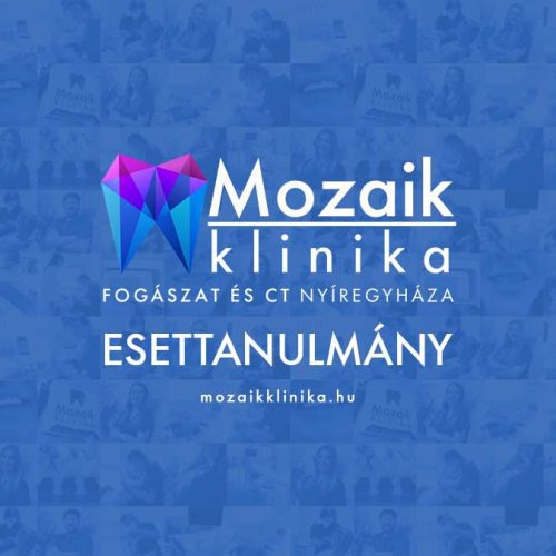 Esztétikus front tömések