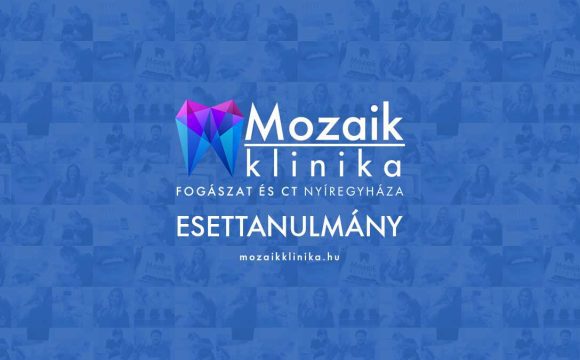 Háromtagú cirkon híd