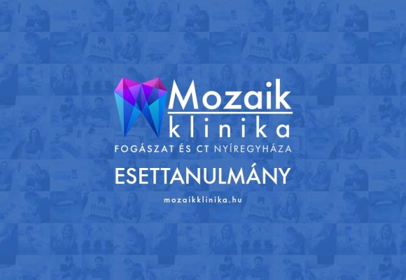 Háromtagú cirkon híd