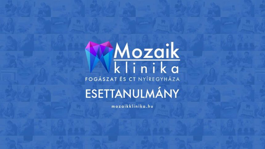 Háromtagú cirkon híd
